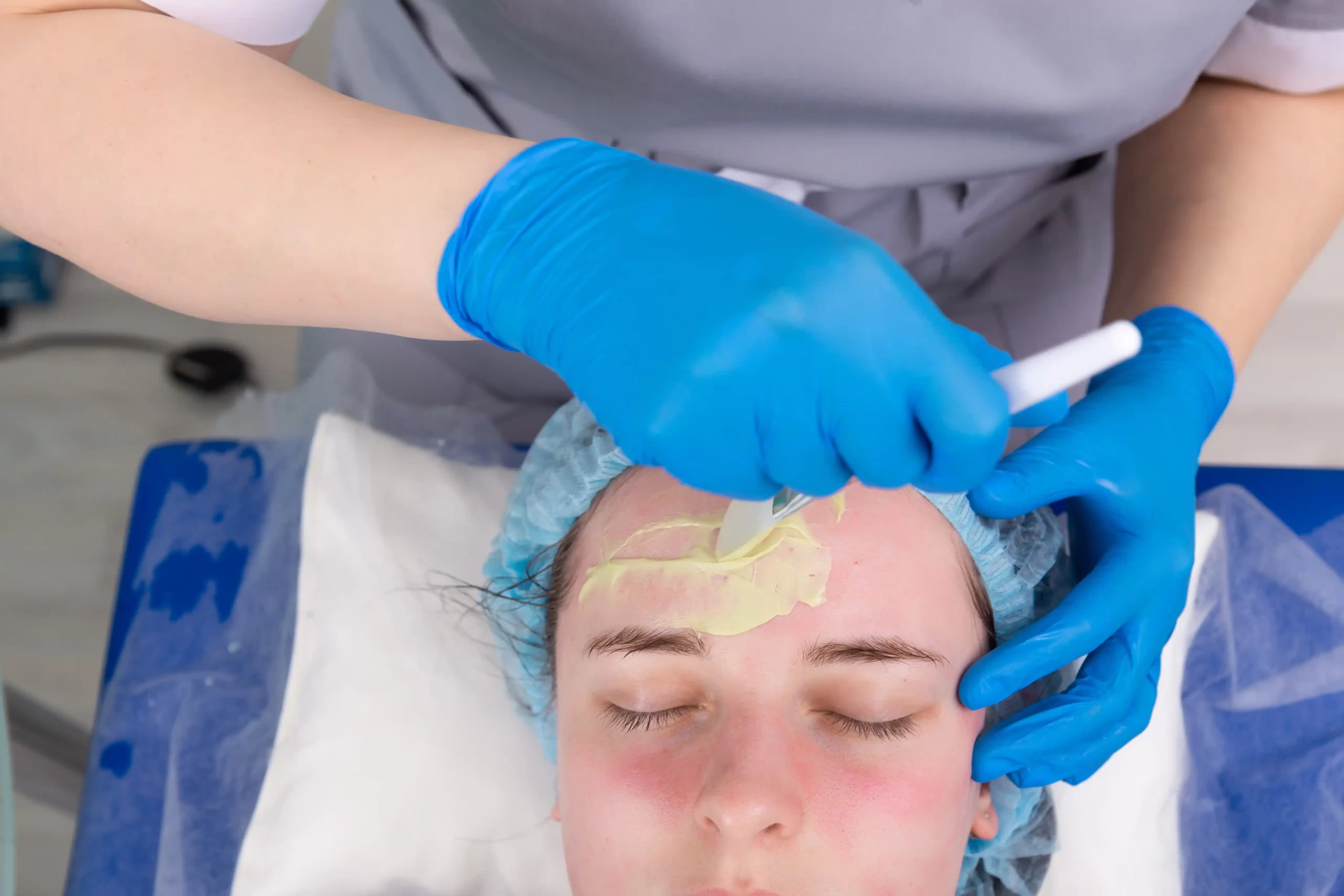 Forehead Hair Removal in Hamilton